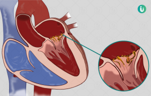 What is endocarditis and its causes?